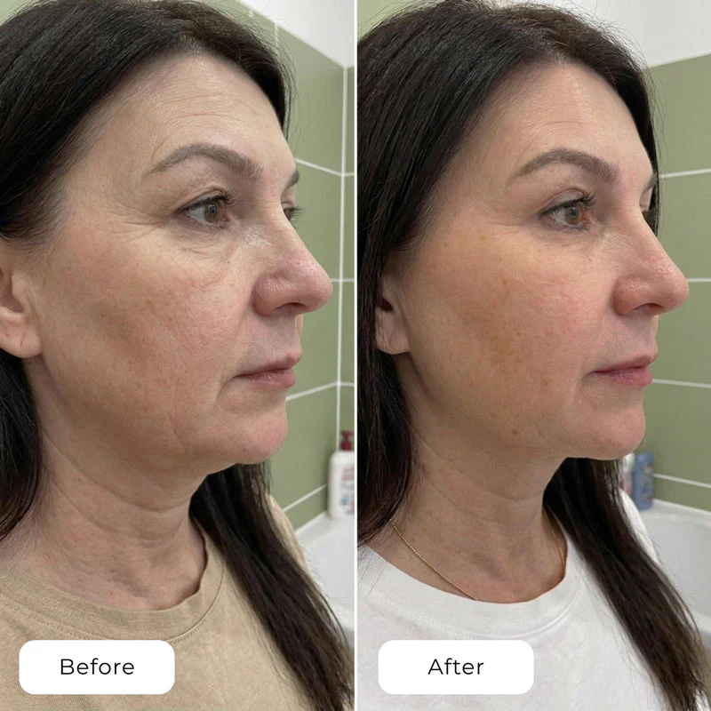 Before and after using Naraskin Lab anti-aging mask