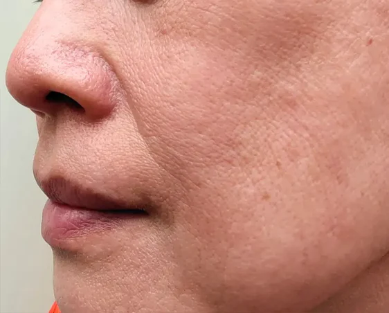 Loss of Facial Definition