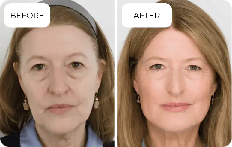 Ammy, 53, CA before and after