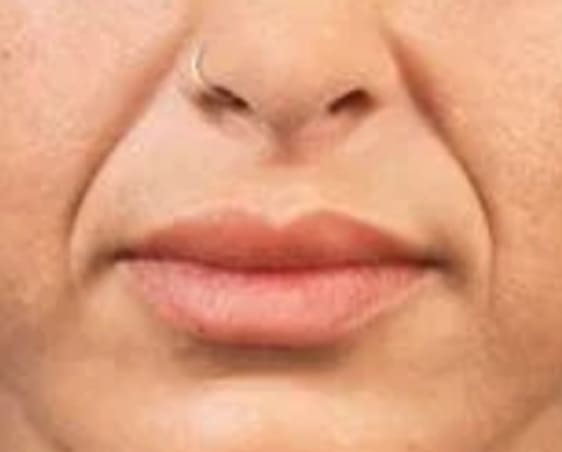 Nasolabial Folds